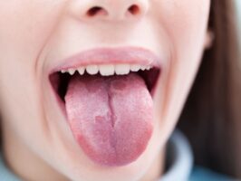 macchie sulla lingua: le cause